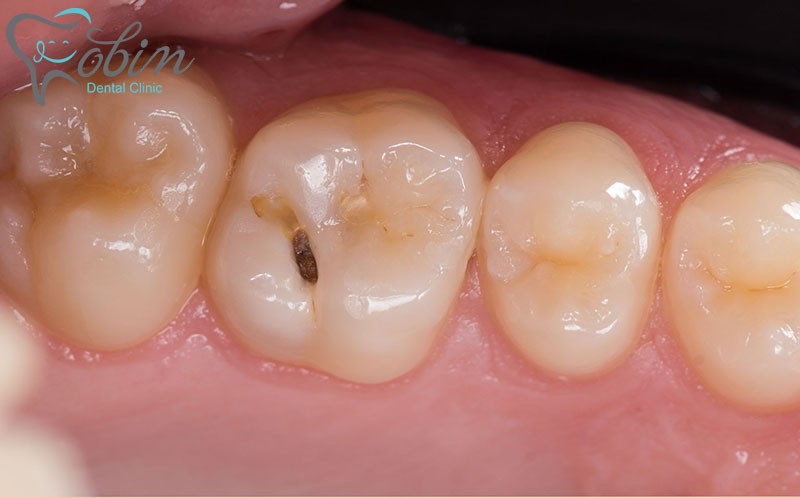 طبقه بندی انواع کامپوزیت دندانی